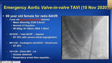 TAVI - From 'inoperable' to routine care?